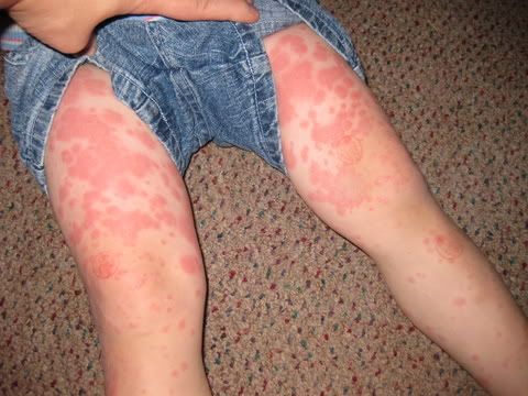 Chicken Pox Legs