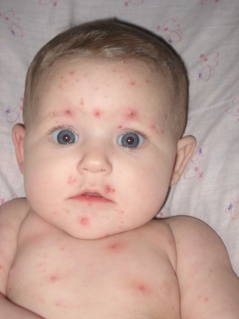 Chicken pox in General Discussion | Forum | Huggies